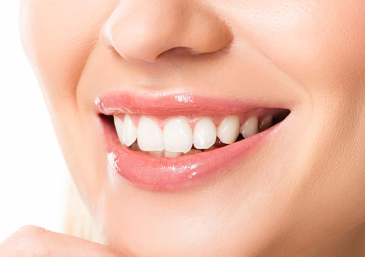 What Are the Benefits of Cosmetic Teeth Veneers?
