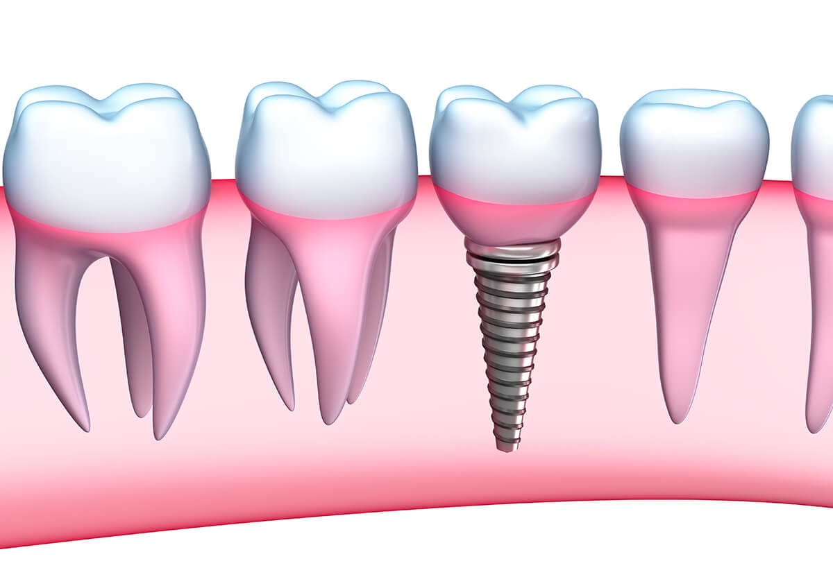 Excel Dental Offers Dental Implants to Replace Missing Teeth
